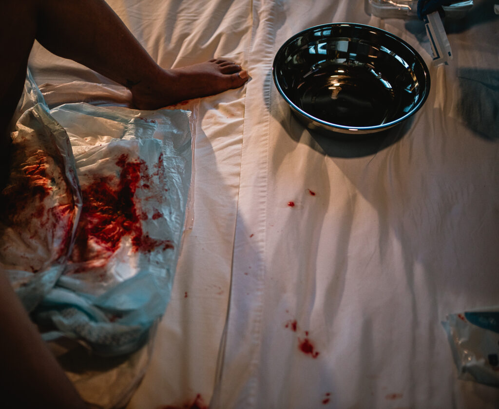Close-up of the placenta and birth supplies resting in a stainless steel bowl after delivery