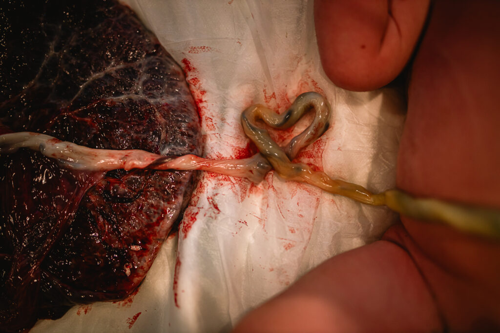 Close-up of placenta with umbilical cord shaped into a small heart