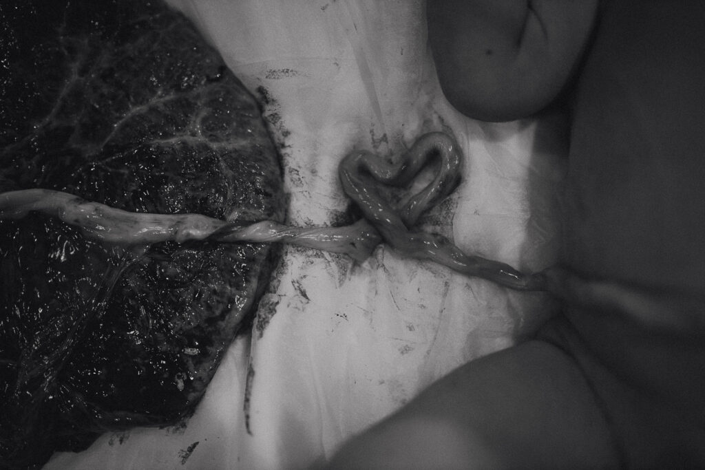 Black and white close-up of placenta and heart-shaped umbilical cord next to baby’s leg